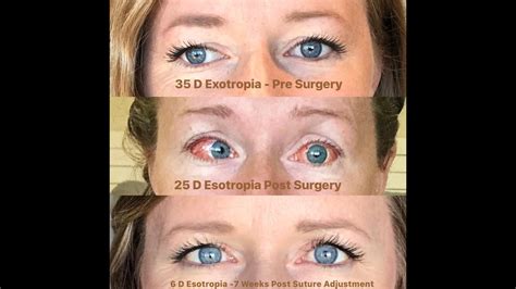 esotropia surgery in adults