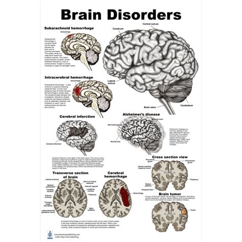 esp brain disorder