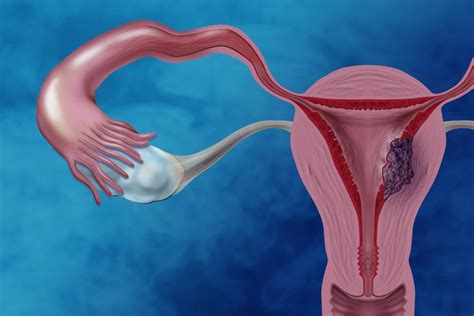 espessamento de endometrio cid