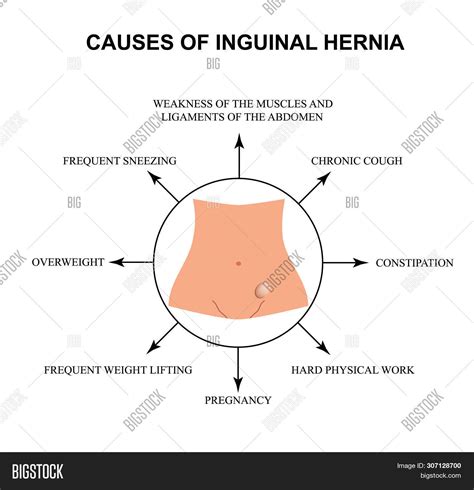 etiology of inguinal hernia