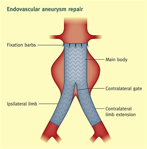 Understanding the Evar Surgical Procedure for Aortic Repair