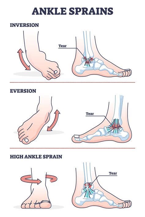 eversion vs inversion ankle sprain