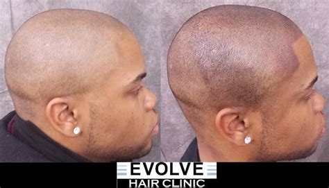 EVOLVE Advanced Hair Restore Stack with Finasteride EVOLVE HRT