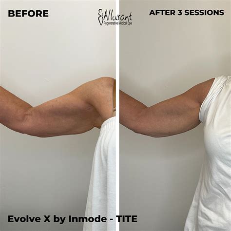 evolvex before and after