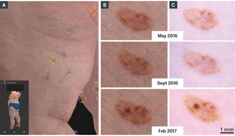evolving melanoma in situ