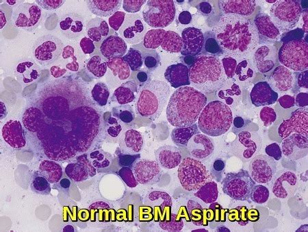 Unveiling the Secrets of Bone Health: The Importance of Examination of Bone Marrow