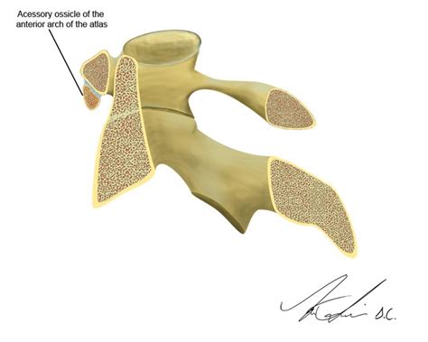 Example Of Accessory Ossicles