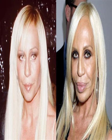examples of bad plastic surgery