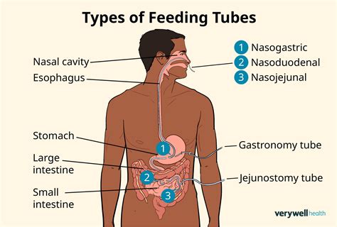 Examples Of Feeding Tubes