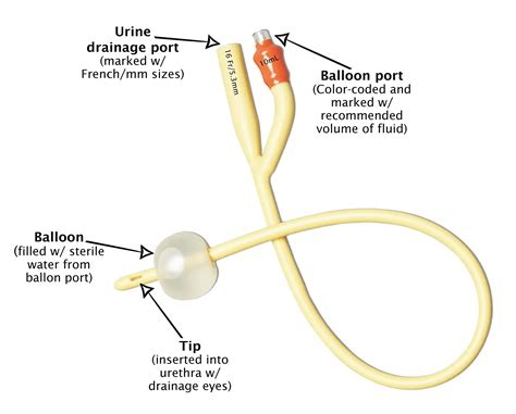 examples of indwelling catheters