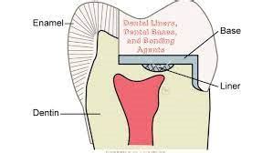 Examples Of Liners In Dentistry