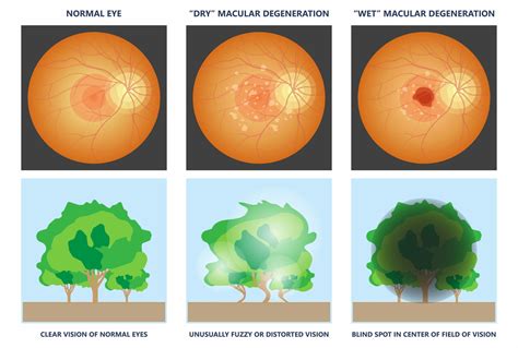Examples Of Macular Degeneration
