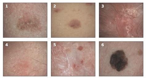 examples of melanoma skin cancer