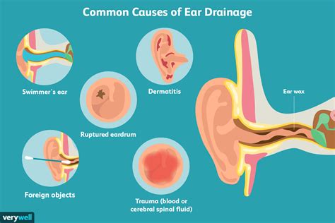 excessive drainage from ear