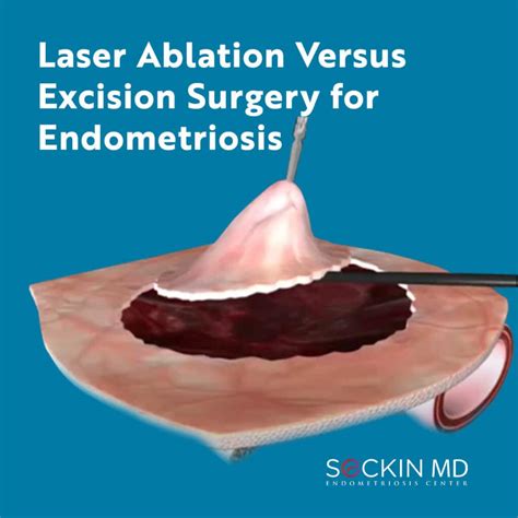 excision surgery for endometriosis near me