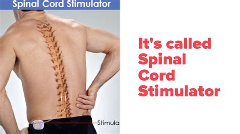 Exercise After Spinal Cord Stimulator