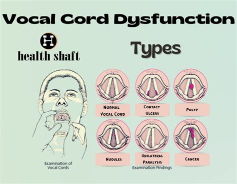 Exercise Vocal Cord Dysfunction