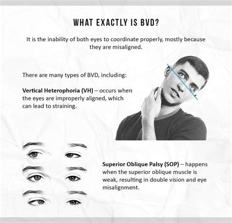 Exercises For Binocular Vision Dysfunction