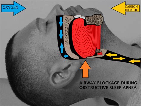 exercises for obstructive sleep apnea