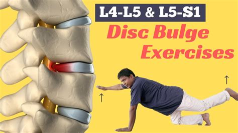 exercises to avoid with bulging disc l5 s1