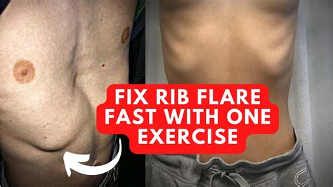 Exercises to Fix Rib Flare
