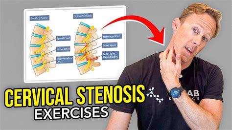 exercises to help with cervical stenosis