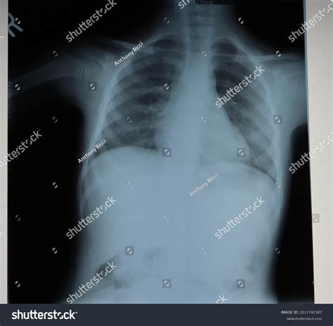 Expanded Chest Meaning