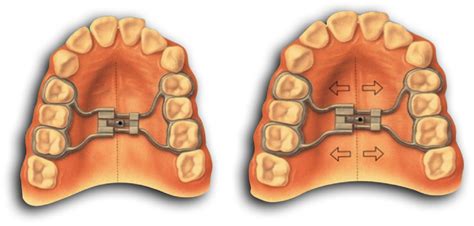 Expander Braces How Long