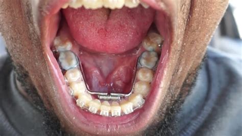 Expander On The Bottom