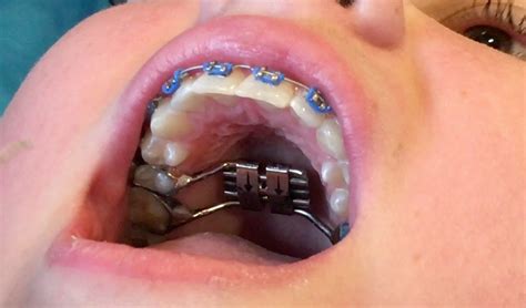 Expanders And Braces At The Same Time