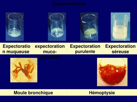 expectoration sanguine