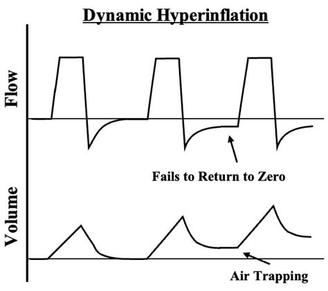 Expiratory Flow Limitation And Dynamic Hyperinflation