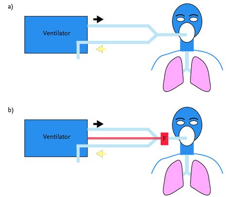 Expiratory Flow Sensor Error