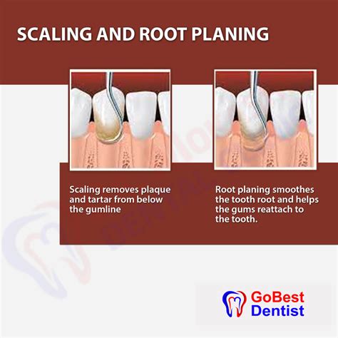 Explain Gross Scaling