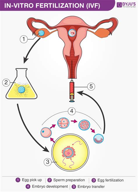 explain in vitro fertilization with diagram
