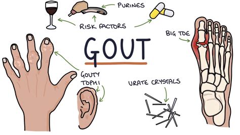 explain what gout is