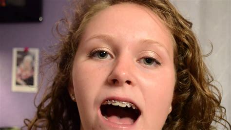 exploitedteens braces