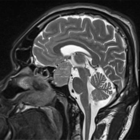 Extension Value Definition