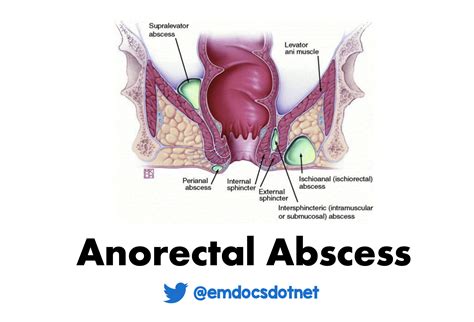 External Hemorrhoid Vs Abscess