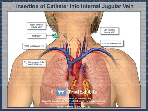 External Jugular Catheter Insertion