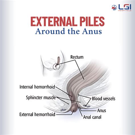 External Piles Define