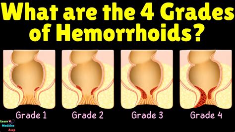 External Piles Stages