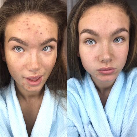 extraction facial before after