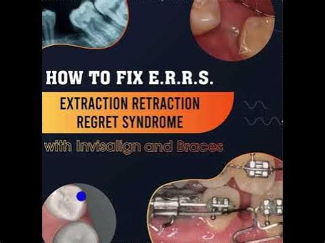 Extraction Retraction Reversal