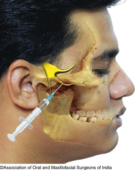 extraoral mandibular nerve block technique