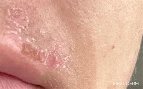 Extremely Dry Skin Around Lips