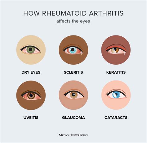 Eye Arthritis Side Effects
