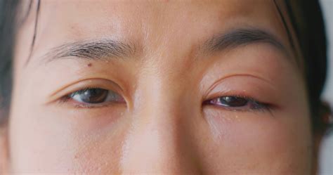 Eye Bleeding After Rubbing