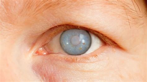 Understanding Eye Disease Glaucoma: Causes, Symptoms, and Treatment Options