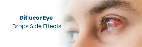Eye Drops For Allergies Side Effects